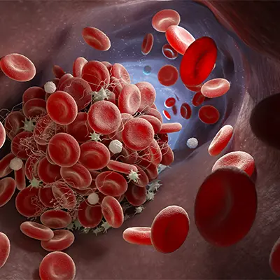 Alteraciones en la coagulación