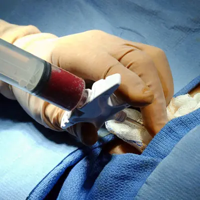 Aspirado de médula ósea