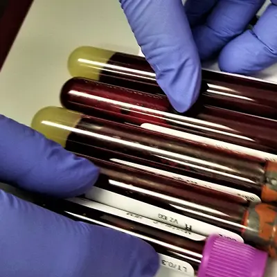 Síndrome mieloproliferativo